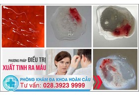 Cách chữa xuất tinh ra máu an toàn