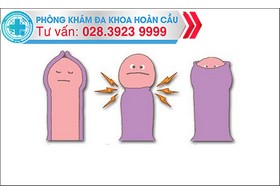 Trường hợp nào nam giới nên cắt bao quy đầu?