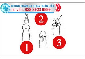 Cắt bao quy đầu ở đâu tại TP.HCM ?