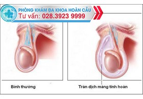 Dấu hiệu nhận biết tràn dịch màng tinh hoàn