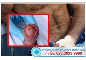 Đau quy đầu dương vật là dấu hiệu của bệnh gì?