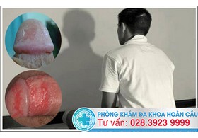 Dương vật bị bong tróc da là dấu hiệu bệnh gì?