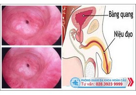 Hẹp niệu đạo ở nam giới và cách chữa trị hiệu quả