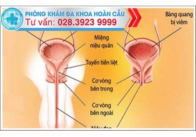 Những nguyên nhân gây viêm bàng quang ở nam giới