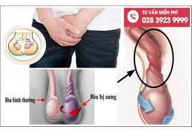 Nguyên nhân gây đau tức bìu và cách chữa trị hiệu quả