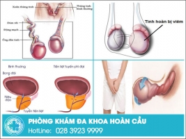 Những bệnh nam khoa dễ mắc ở nam giới