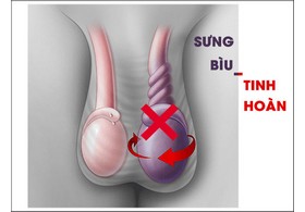Bị Sưng Bìu Tinh Hoàn Ở Nam Giới Là Bệnh Gì?