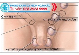 Tinh hoàn bị lạc chỗ là gì
