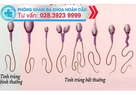 Cách nhận biết sự bất thường của tinh trùng