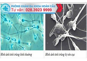 Tinh trùng kết đám có gây vô sinh?