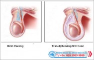 Tràn dịch màng tinh hoàn